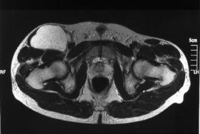 悪性軟部腫瘍 MRI