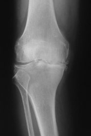 変形性膝関節症 レントゲン