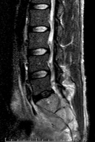 仙骨多発性骨髄腫 MRI