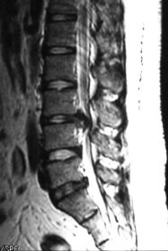 腰部椎間板ヘルニア MRI