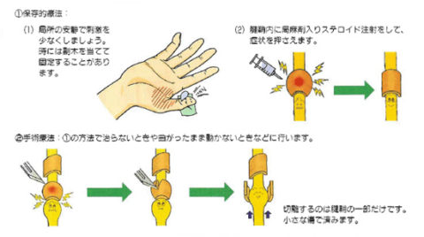 ばね指　治療方法イラスト