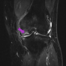 大腿骨顆部骨壊死 MRI