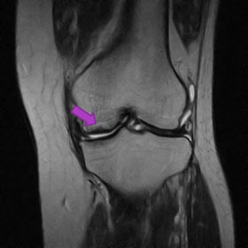 大腿骨顆部骨壊死 MRI