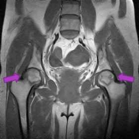 大腿骨頭壊死　MRI