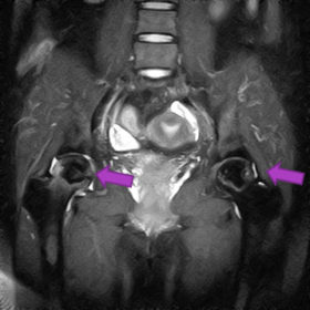 大腿骨頭壊死　MRI