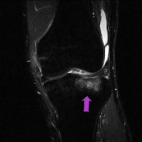 脛骨骨挫傷　MRI