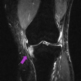 脛骨骨挫傷　MRI