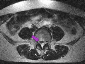 椎間板ヘルニア　MRI